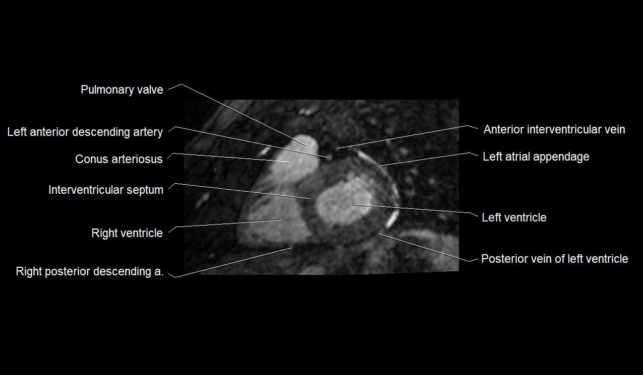 MRI heart and coronary arteries short axis anatomy image 22.webp